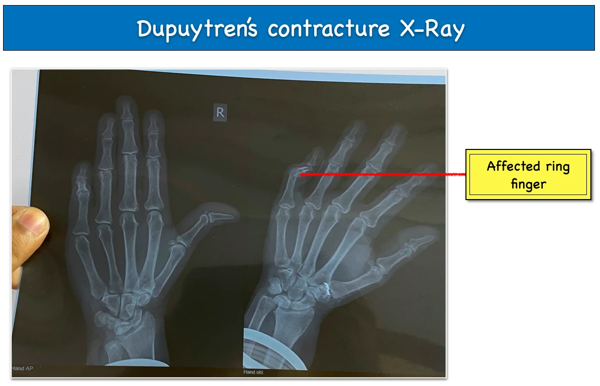 Dupuytren's contracture Xray